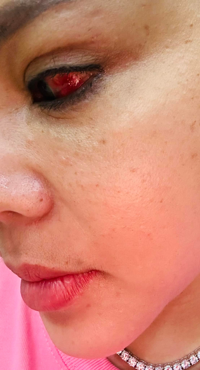 Tình trạng mắt hiện tại của Lê Giang.