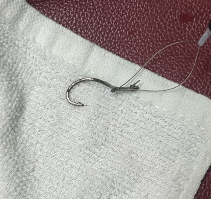 Dị vật là móc câu được các bác sĩ lấy ra khỏi cơ thể bệnh nhân. (Ảnh: BVCC).