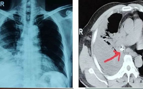 Người đàn ông đau ngực khó thở kéo dài vì lý do bất ngờ Ảnh 2