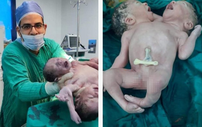 Ai Cập: Cặp song sinh dính liền có 2 đầu, 4 tay và 2 chân Ảnh 2