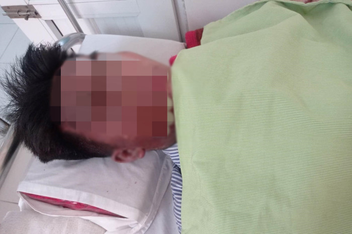 Nam sinh bị hỏng một mắt, nửa mặt bên phải, cổ và ngực bị bỏng rất nặng. (Ảnh: Vietnamnet).