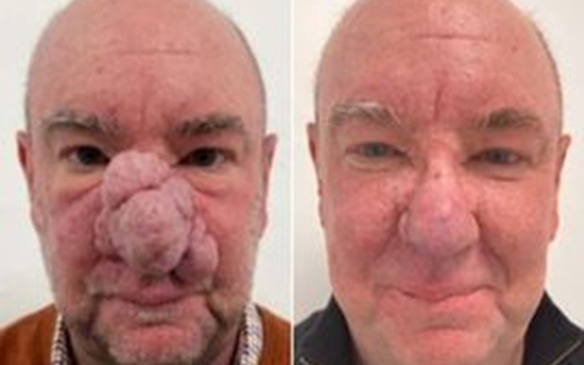 Người đàn ông mũi 'voi' lột xác sau nhiều năm tự ti Ảnh 2