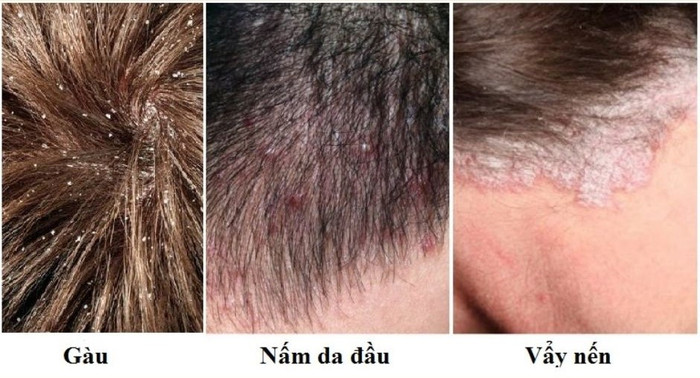 Bệnh lý thường thấy ở da đầu