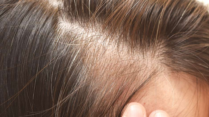 Rụng tóc nhiều làm lộ rõ khoảng trống trên da đầu, tóc mọc xung quanh yếu và thưa thớt
