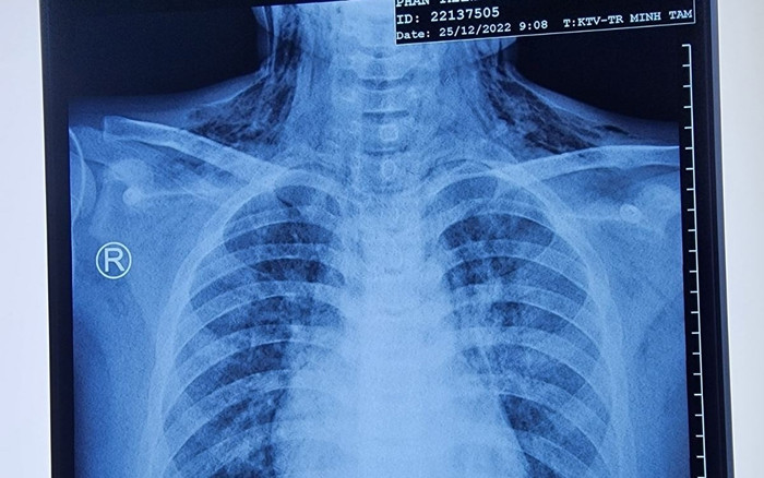 Cậu bé 11 tuổi vẫn bị hóc sặc dị vật, bác sĩ đưa ra khuyến cáo Ảnh 2