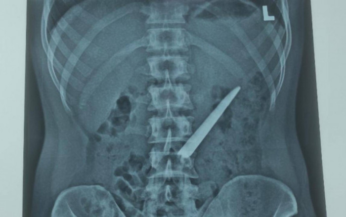 Thanh niên bất ngờ nhập viện với lưỡi dao nhọn dài khoảng 10cm trong bụng Ảnh 2