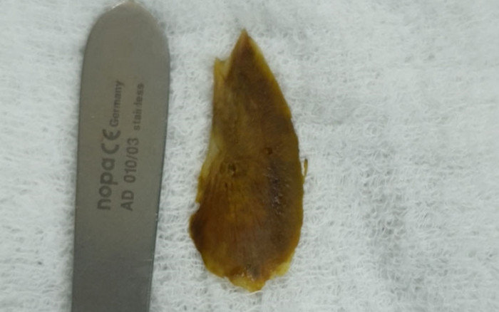 Vô tình nuốt phải thứ này, cụ bà bị thủng ruột non nhập viện khẩn Ảnh 2