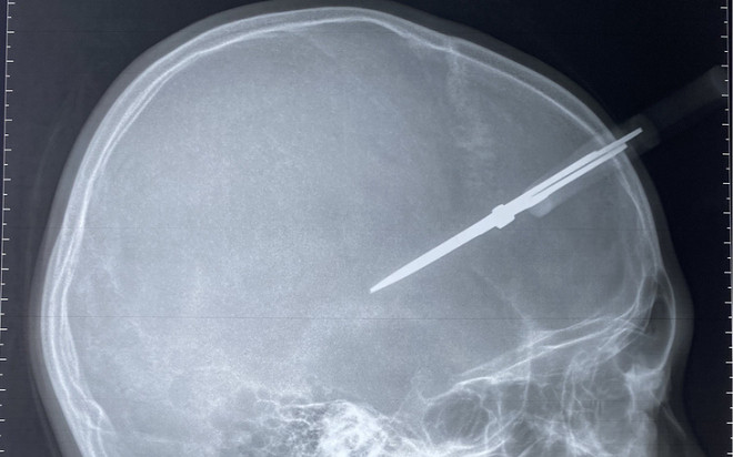 Trước ngày nghỉ Tết, bé trai bị kéo đâm thủng hộp sọ khi đang chơi đùa trong lớp Ảnh 2