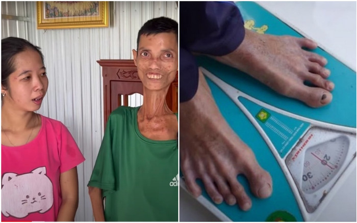 Người đàn ông 'ăn mãi chẳng lớn' chỉ nặng 20kg, vẫn đau đau khát khao 2 vợ chồng có một thiên thần nhỏ Ảnh 2