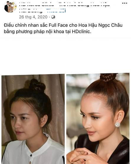 Theo bài viết được đăng tải của một thẩm mỹ viện, Ngọc Châu đã thực hiện thay đổi nhan sắc toàn bộ gương mặt bằng phương pháp nội khoa. 