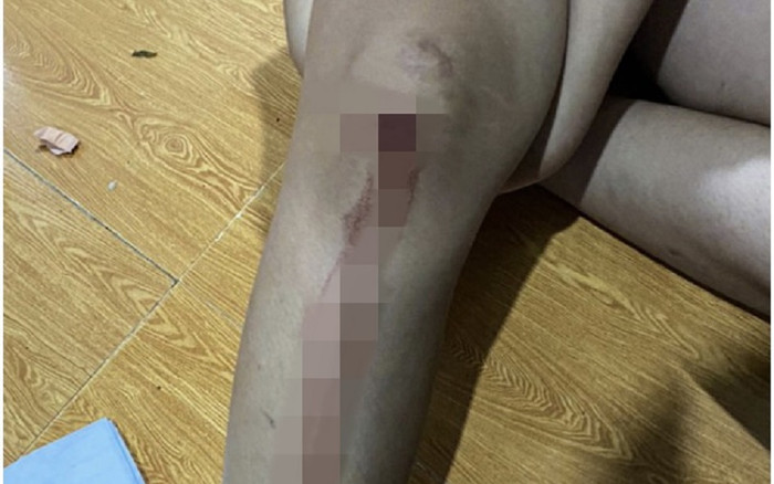 2 chị em bất ngờ bị kẻ lạ mặt chĩa súng bắn gây thương tích Ảnh 2