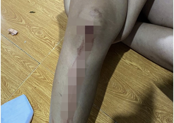 Chân bé gái bị thương do bị đạn găm trúng