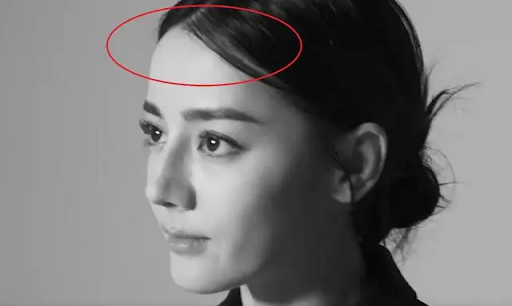 Nhiều người phát hiện đường chân tóc của Địch Lệ Nhiệ Ba trở nên cao hơn, tóc mỏng và ít đi rõ rệt so với trước đây