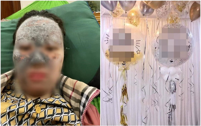 Mặt cô gái biến dạng vì bóng bay trang trí phòng cưới phát nổ, chuyên gia đưa ra cảnh báo quan trọng Ảnh 2