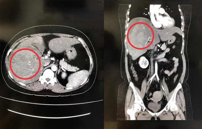 Ảnh chụp CT-scan cho thấy gan phải bị vỡ. (Ảnh: BVCC).