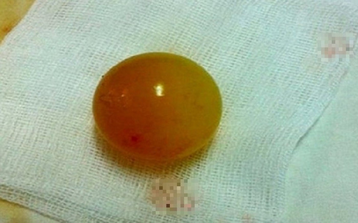 Bé gái 13 tháng tuổi phải nhập viện mổ khẩn cấp vì nuốt món đồ quen thuộc Ảnh 2