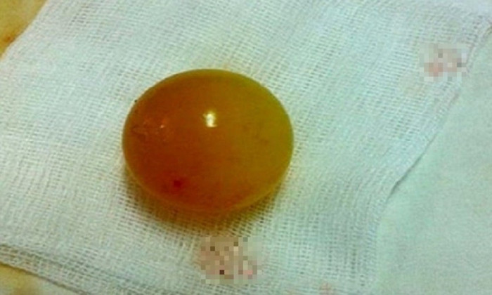  Bé gái 13 tháng tuổi phải nhập viện mổ khẩn cấp vì nuốt món đồ quen thuộc Ảnh 1