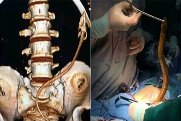 Nhét lươn vào hậu môn chữa táo bón, người đàn ông rước họa vào thân Ảnh 1
