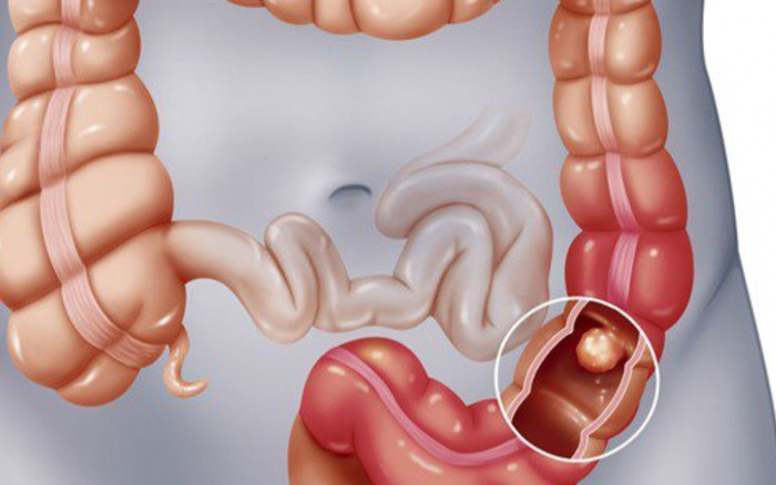 Căn bệnh NSƯT Vũ Linh đối mặt những năm tháng cuối đời nguy hiểm thế nào? Ảnh 2