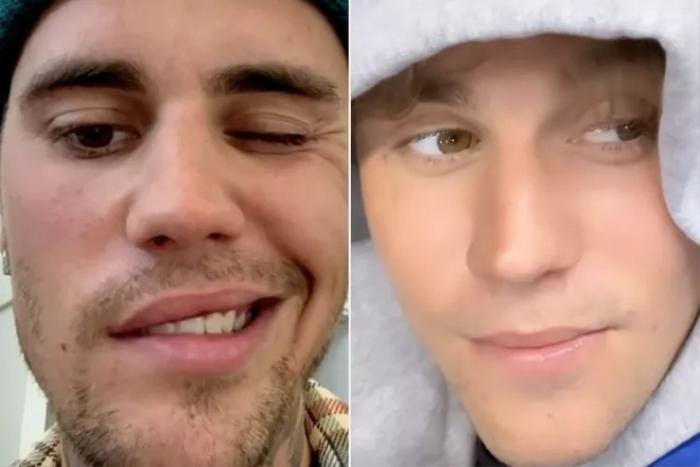 Tình trạng sức khỏe của Justin Bieber sau 10 tháng được chẩn đoán mắc bệnh liệt cơ mặt Ảnh 2