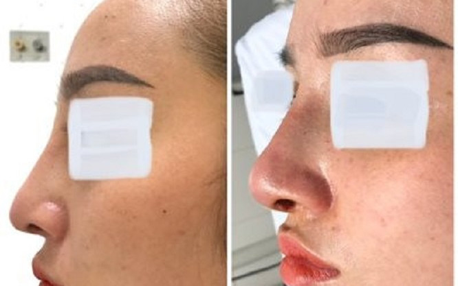 Cô gái 26 tuổi bị áp xe sau khi phẫu thuật nâng mũi Ảnh 2