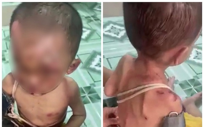 Xót xa hình ảnh bé trai hơn 1 tuổi chằng chịt vết thương nghi bị bạo hành Ảnh 2