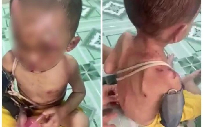 Vụ bé trai bị thương khắp người: Người mẹ ruột thừa nhận có đánh con Ảnh 2