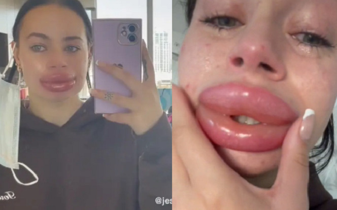 Ham hố dịch vụ tiêm môi miễn phí, cô gái suýt ngất khi nhìn mặt mình trước gương Ảnh 2