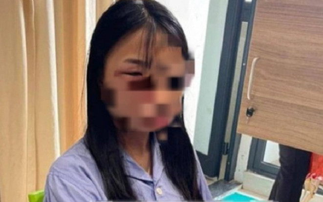 Giám định thương tích nữ sinh lớp 8 ở Hà Nội bị nhóm bạn đánh dã man, phải nhập viện Ảnh 2