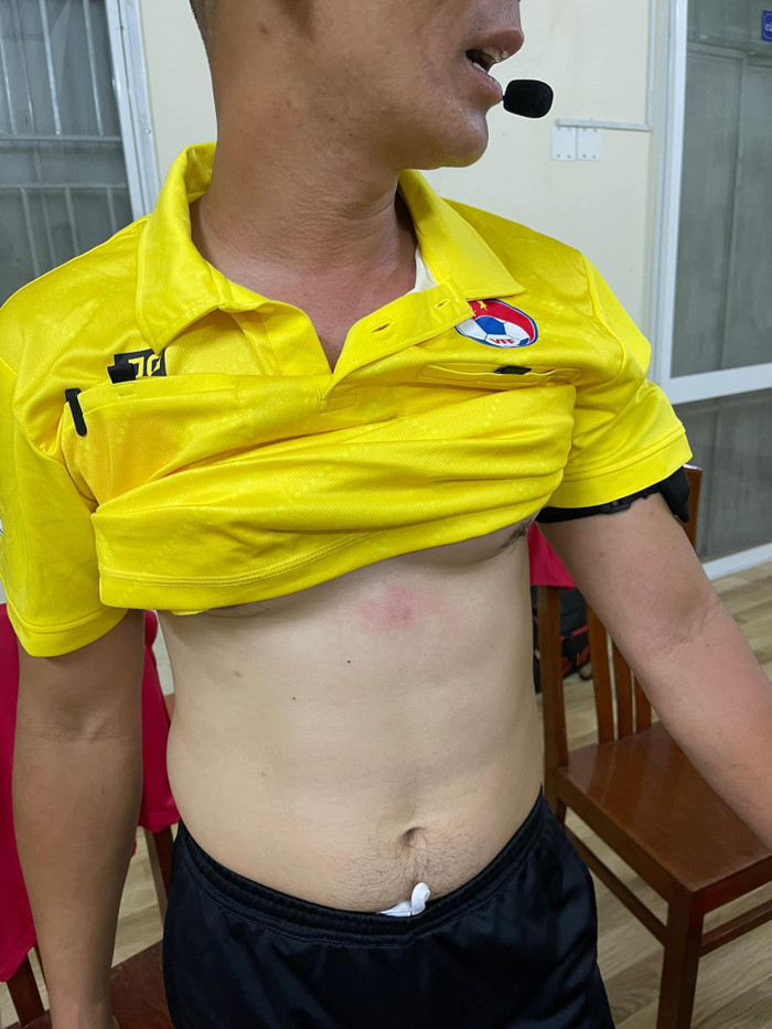 Cận cảnh vết thương của trợ lý trọng tài bị Văn Quyết thúc chỏ, nôn Ảnh 1