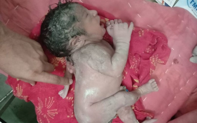 Em bé chào đời với cánh tay thứ ba mọc thêm ở sau lưng cực kỳ hiếm gặp Ảnh 2