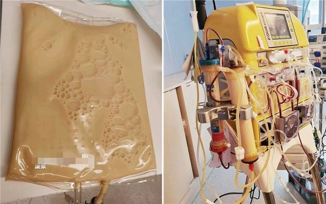 Suýt mất mạng vì ăn thịt heo quay, người phụ nữ máu vàng như mỡ Ảnh 2