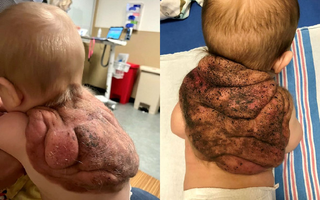 Cậu bé với chiếc 'mai rùa' cõng trên lưng và cái kết mỹ mãn sau quãng thời gian không thể nằm ngửa Ảnh 2