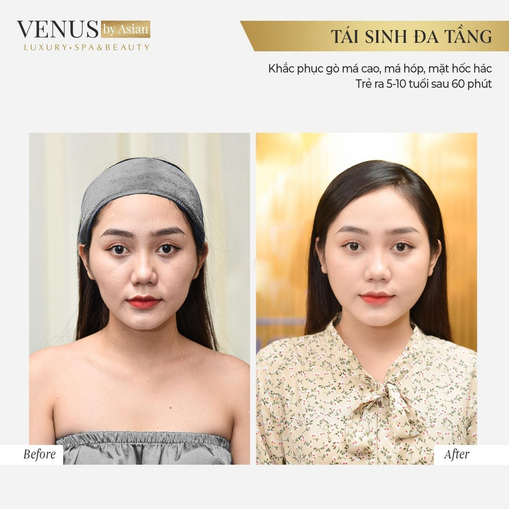 Tái sinh đa tầng công nghệ làm đẹp không xâm lấn đi đầu 2021 Ảnh 3