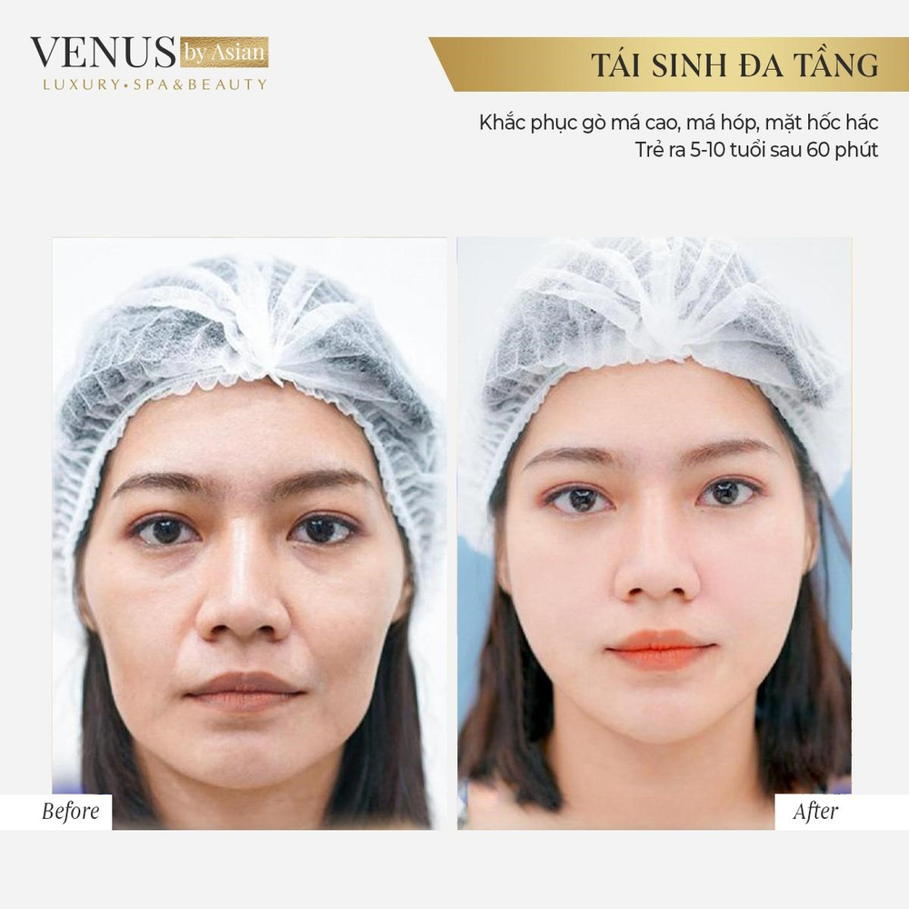 Tái sinh đa tầng công nghệ làm đẹp không xâm lấn đi đầu 2021 Ảnh 4