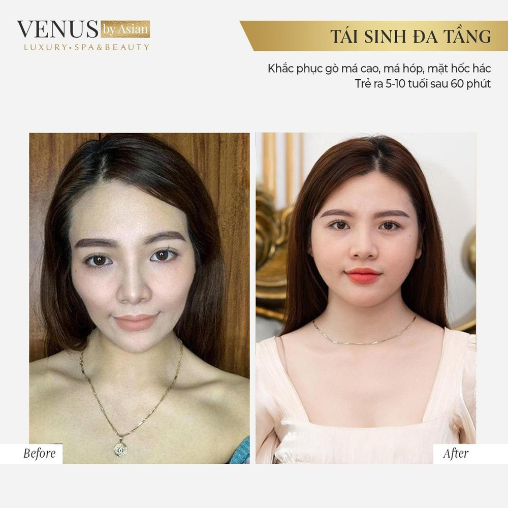 Tái sinh đa tầng công nghệ làm đẹp không xâm lấn đi đầu 2021 Ảnh 5