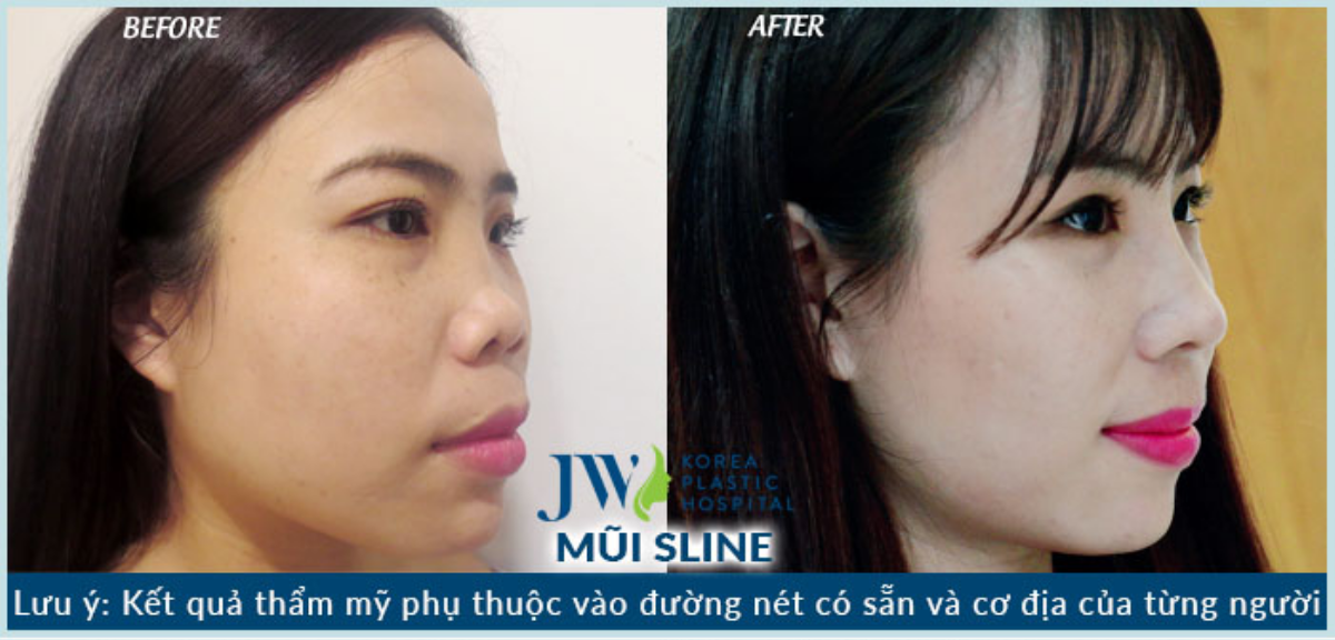 Nóng: Hỗ trợ 100% chi phí đối với những trường hợp làm mũi khó Ảnh 3