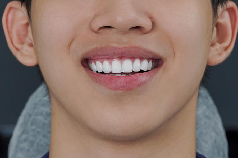 Top 7 dáng răng sứ nam đẹp được ưa chuộng nhất hiện nay Ảnh 3