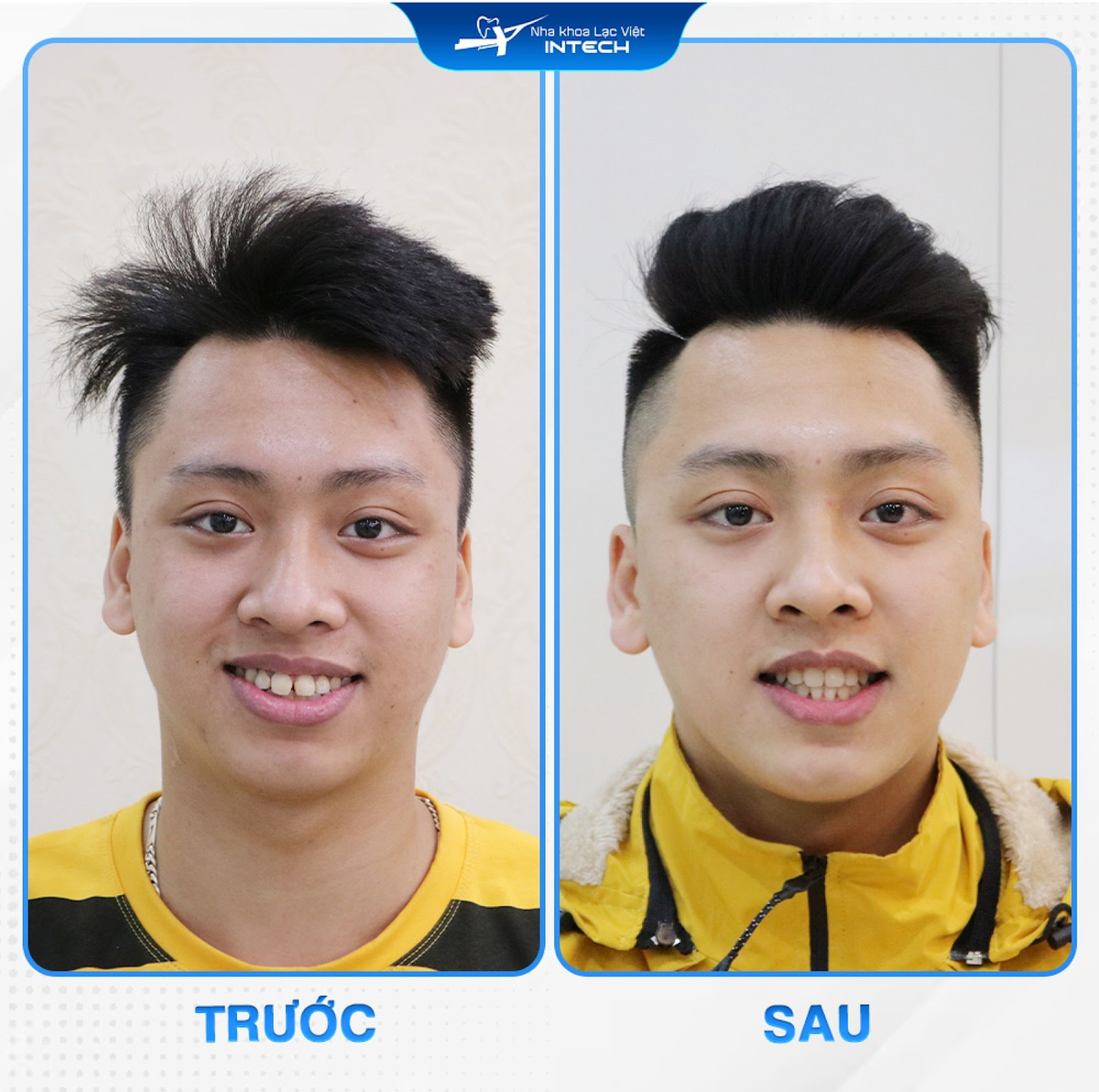 Niềng răng X-Matrix có khả năng tái cấu trúc tầng mặt dưới, giúp khuôn mặt cân đối