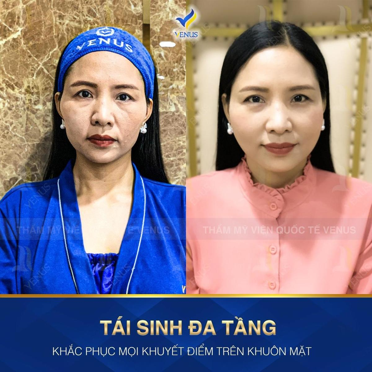 Công nghệ Tái sinh đa tầng duy trì được bao lâu? Ảnh 3