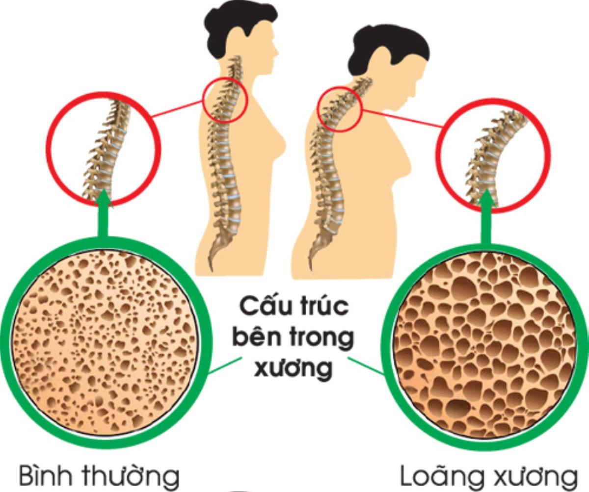 Sữa non: Từ khoá hoàn hảo cho phụ nữ trung niên thiếu canxi Ảnh 1