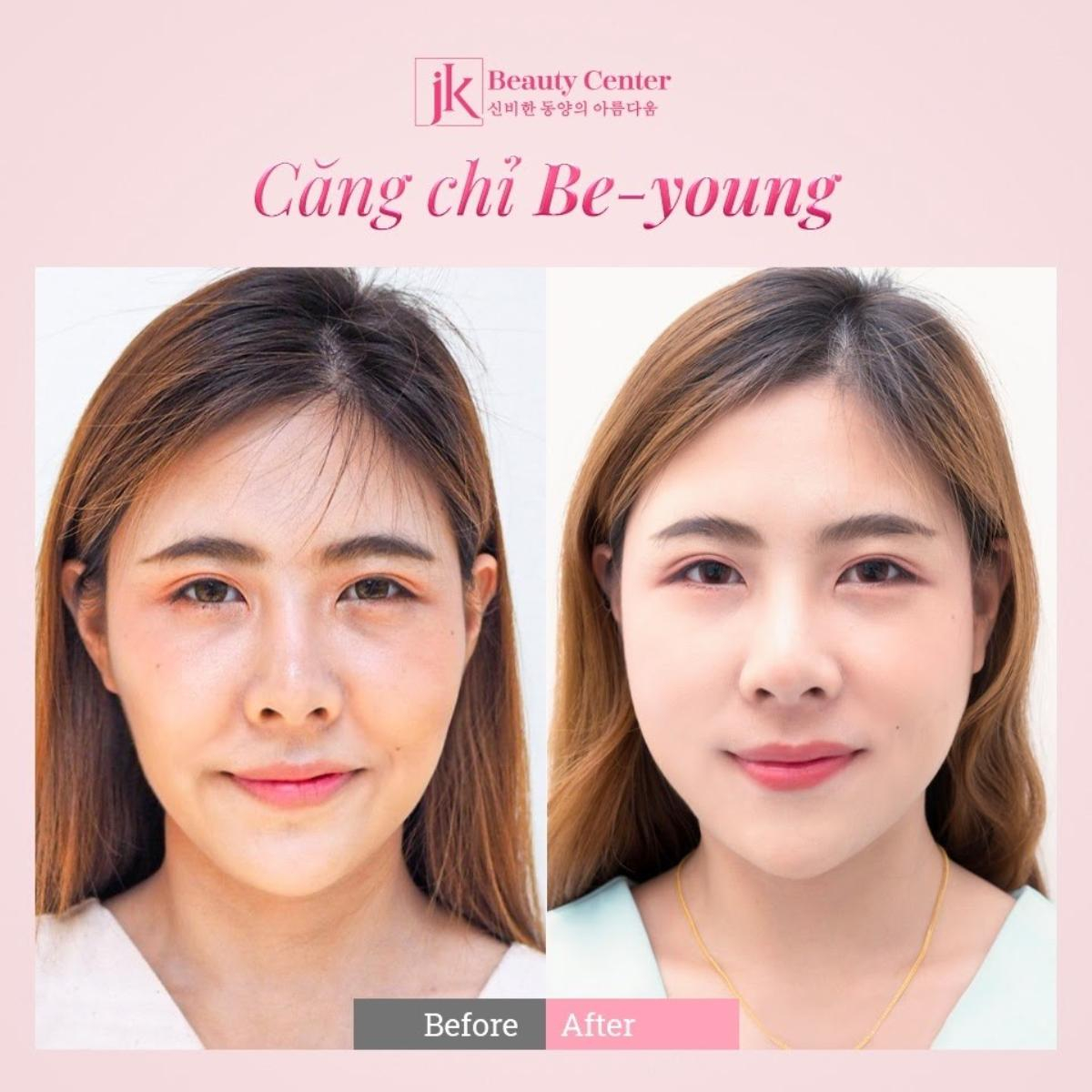 Phụ nữ Việt phát sốt với công nghệ căng chỉ Be - Young chuẩn y khoa hiện đại từ Hàn Quốc Ảnh 5