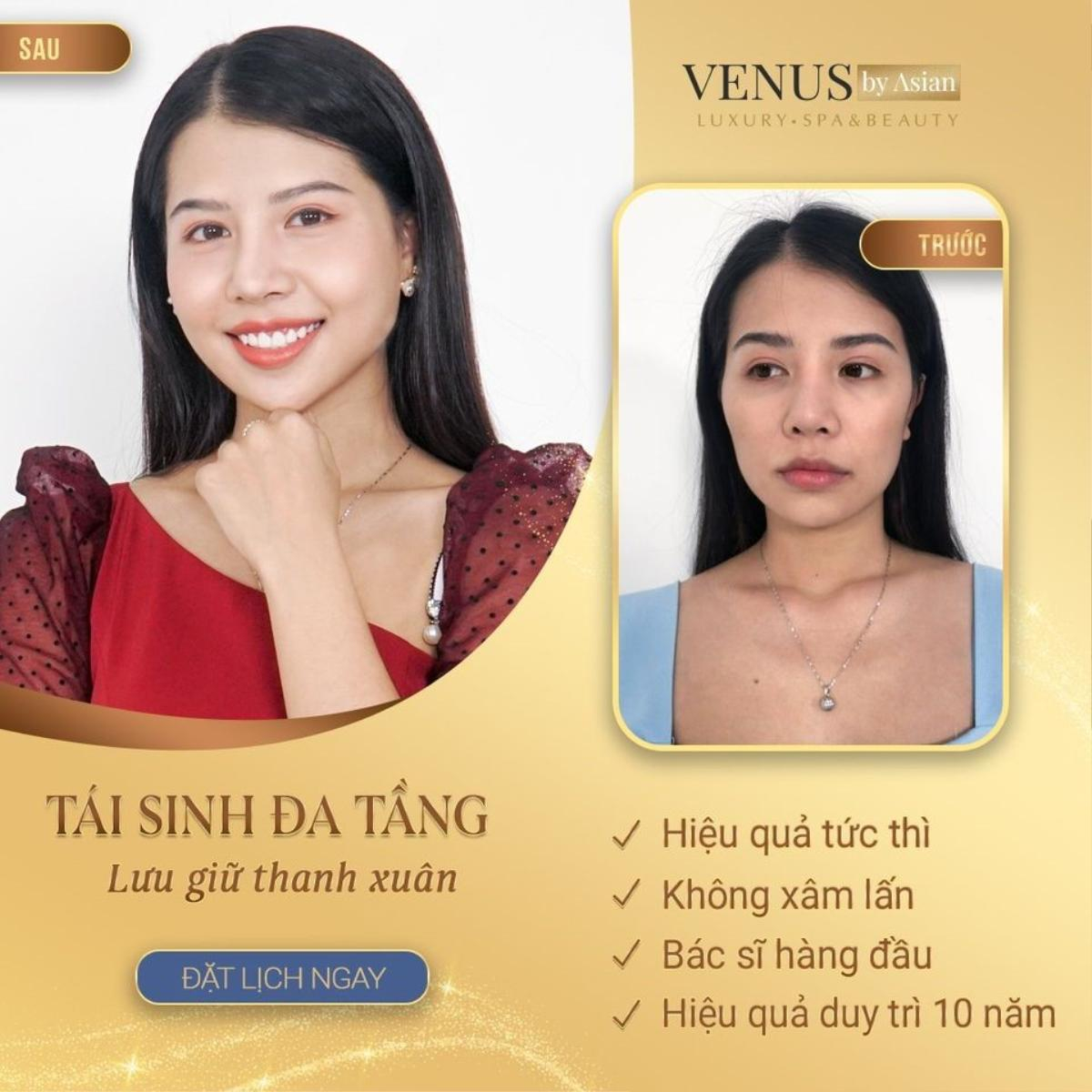 Hơn 10.000 chị em đã lột xác hoàn hảo sau khi thực hiện Tái sinh đa tầng tại Venus by Asian Ảnh 1