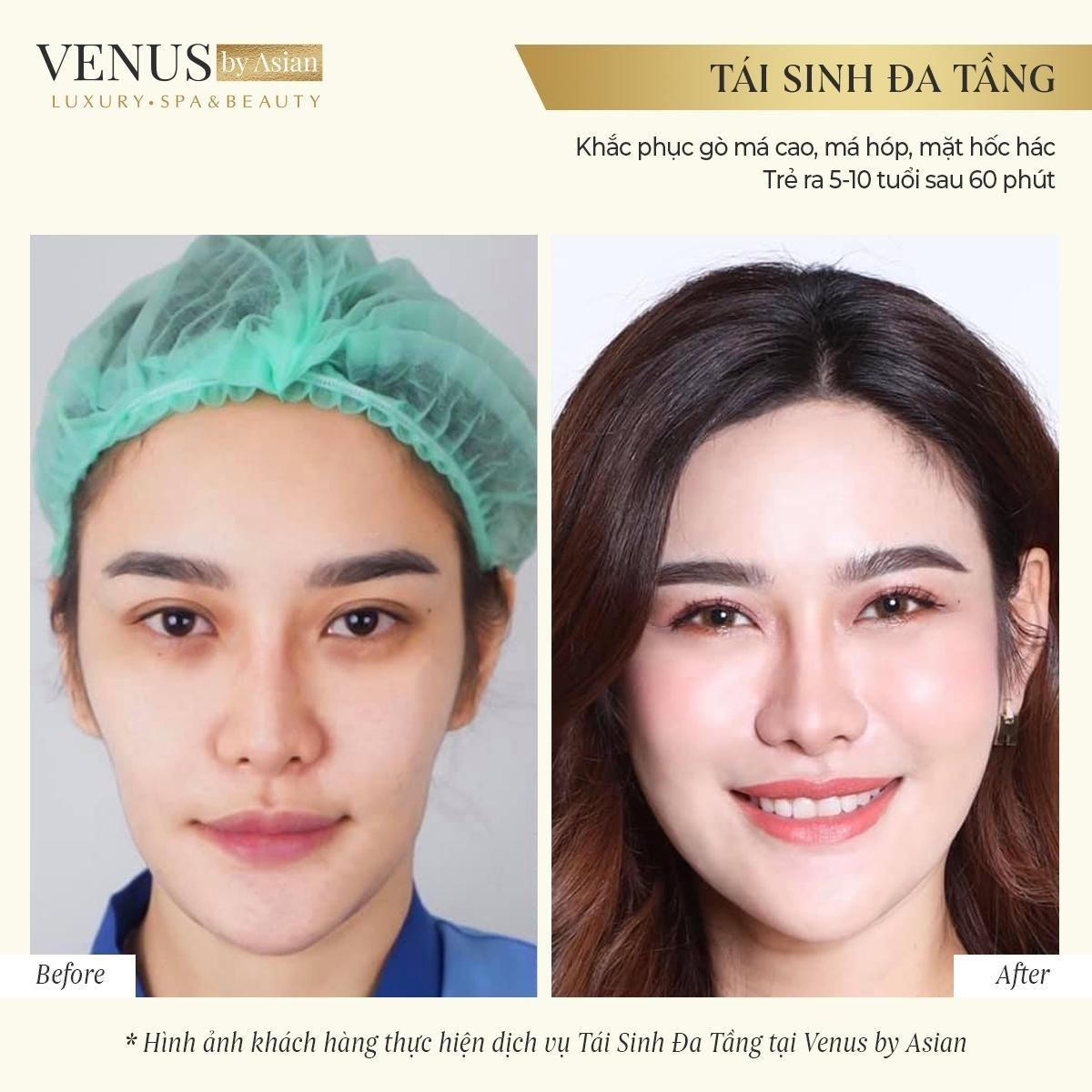 Hơn 10.000 chị em đã lột xác hoàn hảo sau khi thực hiện Tái sinh đa tầng tại Venus by Asian Ảnh 3