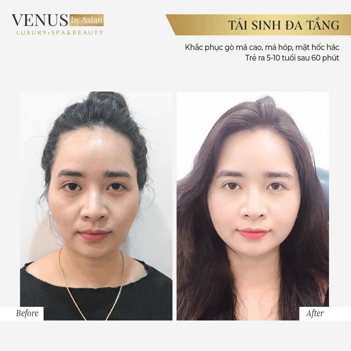 Hơn 10.000 chị em đã lột xác hoàn hảo sau khi thực hiện Tái sinh đa tầng tại Venus by Asian Ảnh 4