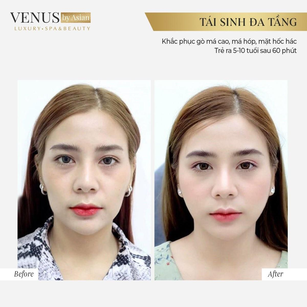 Hơn 10.000 chị em đã lột xác hoàn hảo sau khi thực hiện Tái sinh đa tầng tại Venus by Asian Ảnh 6