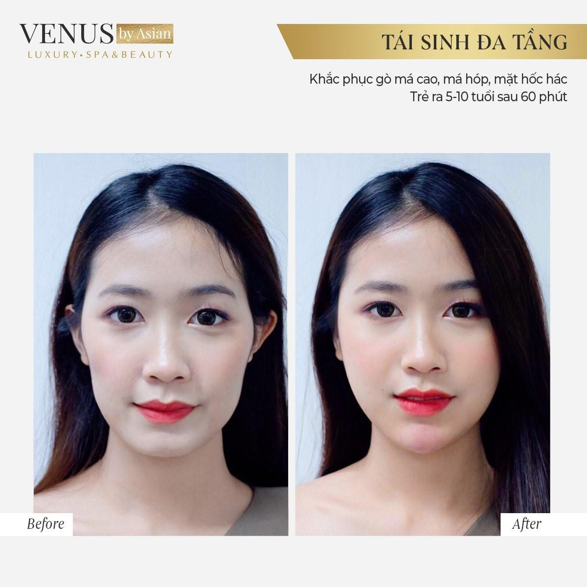 Hơn 10.000 chị em đã lột xác hoàn hảo sau khi thực hiện Tái sinh đa tầng tại Venus by Asian Ảnh 7