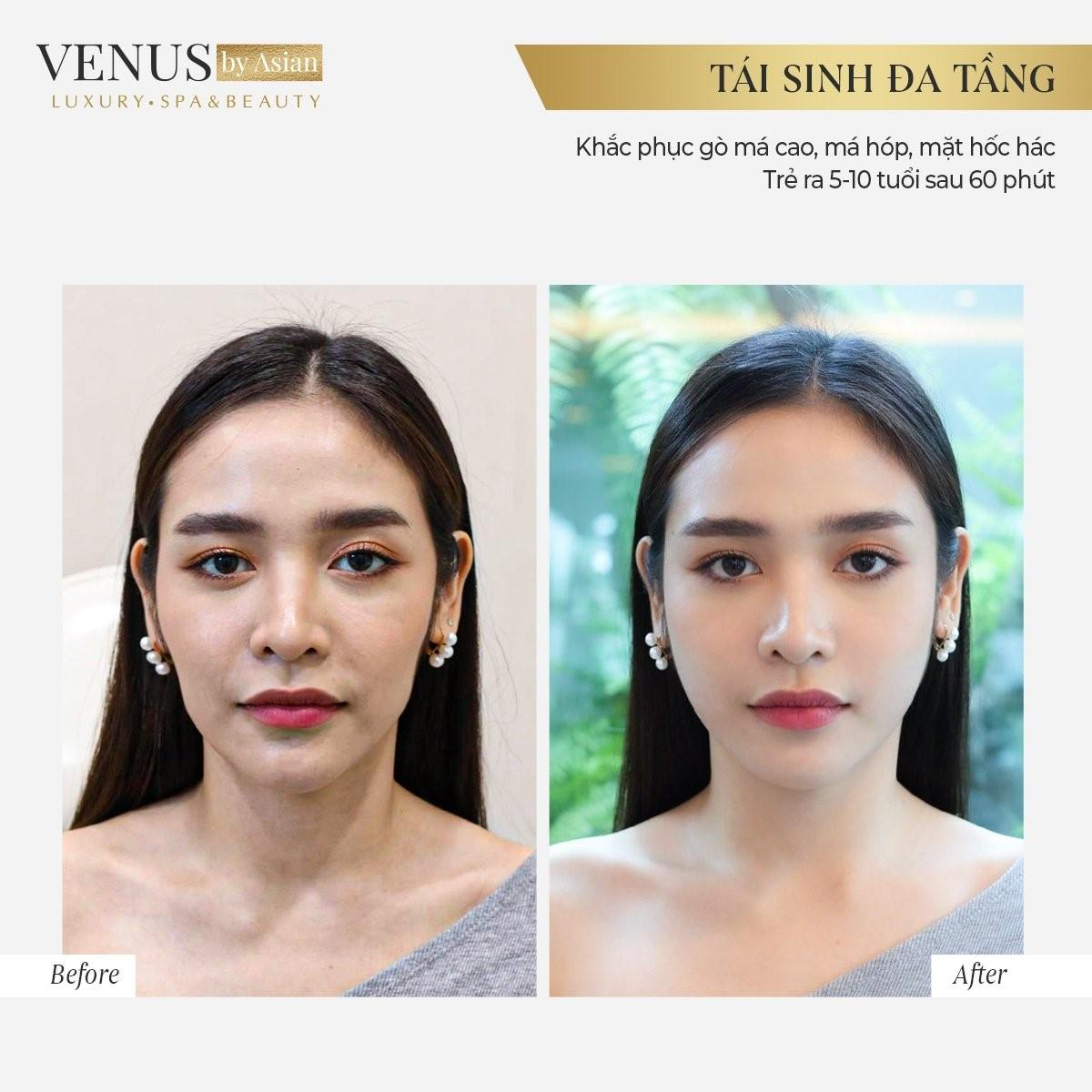 Tái sinh đa tầng lưu giữ thanh xuân tại Venus by Asian có tốt không? Ảnh 1