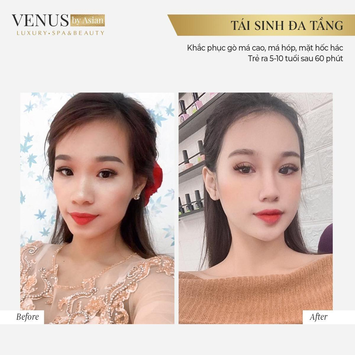 Tái sinh đa tầng lưu giữ thanh xuân tại Venus by Asian có tốt không? Ảnh 2