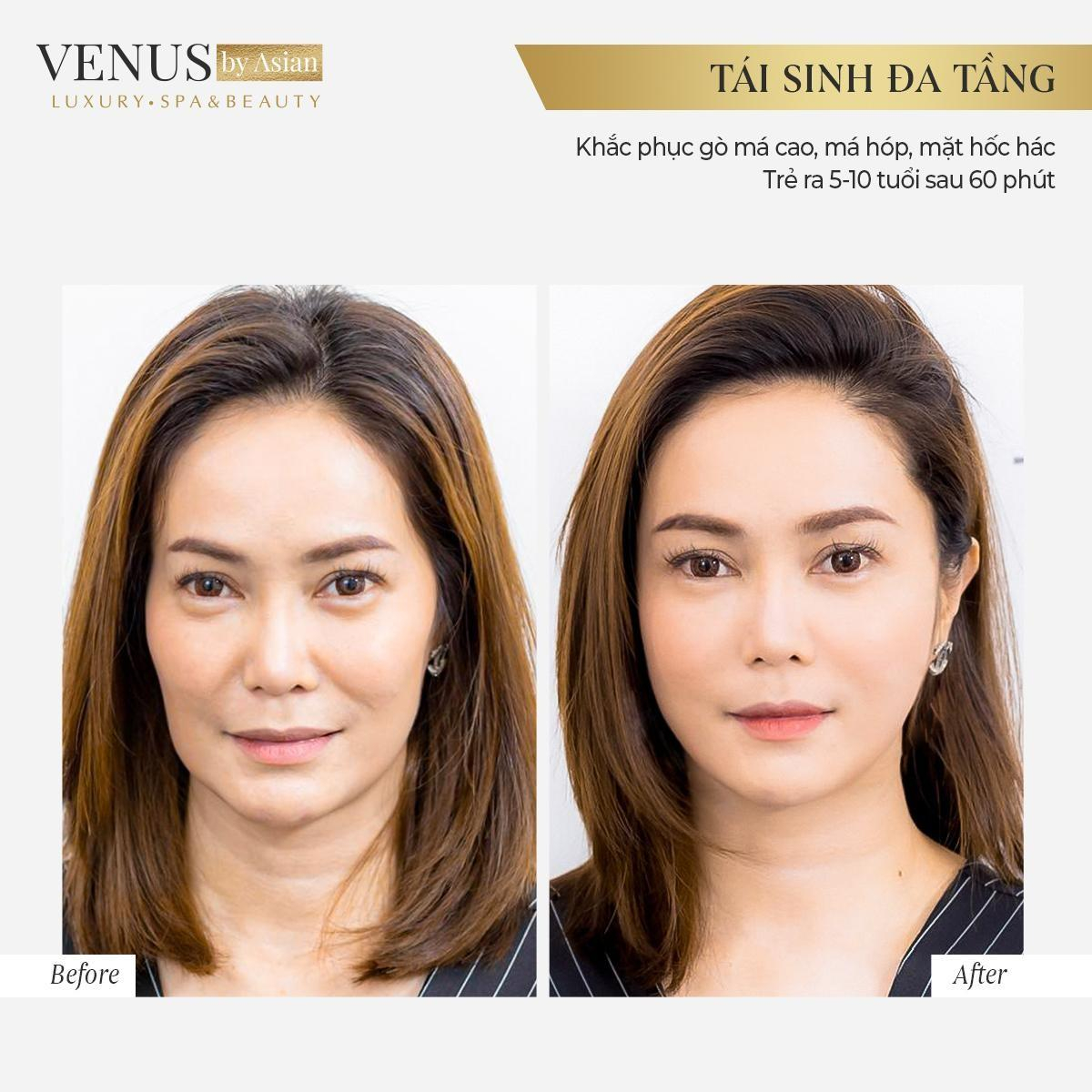 Tái sinh đa tầng lưu giữ thanh xuân tại Venus by Asian có tốt không? Ảnh 3